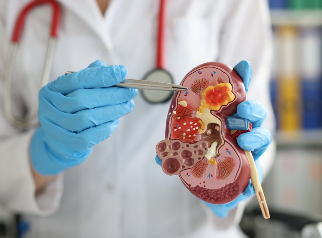 Doença Renal Crônica: Tudo que Você Precisa Saber