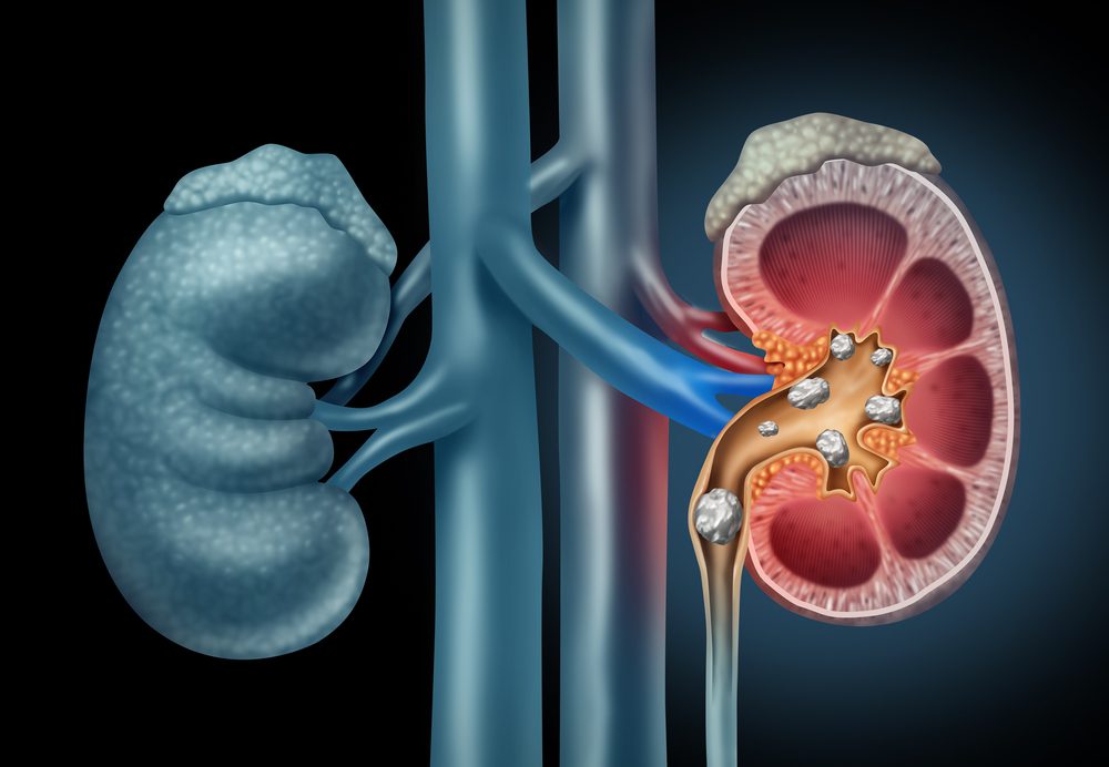 Pedra nos rins: O Risco de Perder Função Renal e a Importância do Acompanhamento com Nefrologista